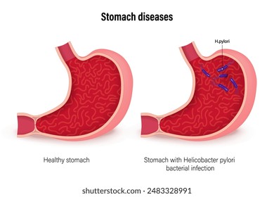 Stomach diseases. Comparison of healthy stomach and Stomach with Helicobacter pylori bacterial infection. Vector for use in scientific and medical education. 
