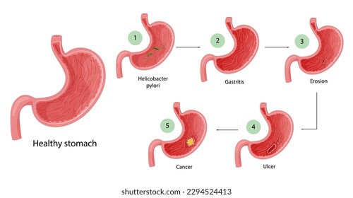 Stomach diseases. Diagram of diseases of helicobacter pylori, gastritis, erosion, ulcer and cancer. Educational anatomical vector illustration isolated white background cartoon style