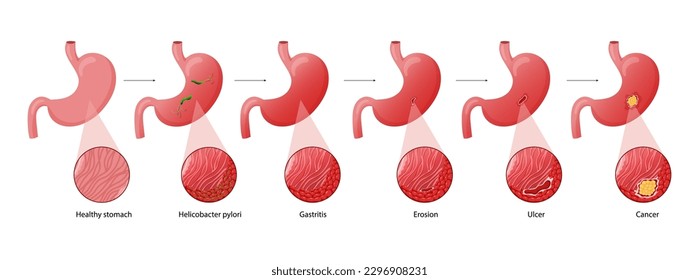 Enfermedades de estómago. Diagrama de enfermedades de helicobacter pylori, gastritis, erosión, úlcera y cáncer. Ilustración de vector anatómico aislado estilo de caricatura de fondo blanco