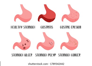 Stomach diseases. Gastritis, gastric erosion, ulcer, cancer, polyp. Gastroenterology. Vector flat illustration. Perfect for flyer, medical brochure, banner, landing page, website