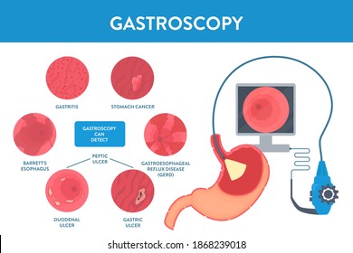 Stomach diseases and gastroscopy procedure equipment for diagnostics. Gastrointestinal tract examination. Medical concept. Vector illustration in flat style. Human body organ anatomy and health care.