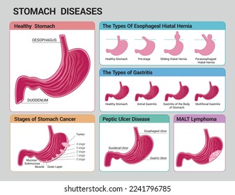 Stomach diseases: peptic ulcer, hiatal hernia, types of gastritis, stages of stomach cancer, MALT lymphoma with pink stomach on white background. Vector illustration.