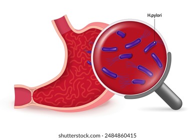 Stomach diseases vector. Helicobacter Pylori in the stomach. Bacterium that causes gastritis. Magnifying glass with bacteria.