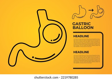 Stomach Endoscopy Gastric Balloon Inside a Stomach weight loss surgery vector illustration obesity 
