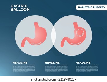 Stomach Endoscopy Gastric Balloon Inside A Stomach Weight Loss Surgery Vector Illustration Obesity 
