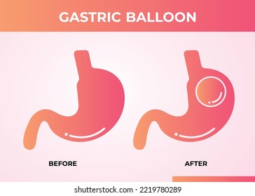 Stomach Endoscopy Gastric Balloon Inside a Stomach weight loss surgery vector illustration obesity 
