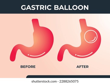 Stomach Endoscopy Gastric Balloon Inside a Stomach weight loss surgery vector illustration obesity 
