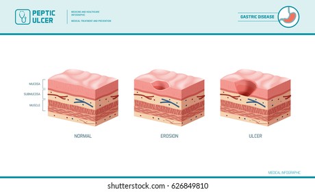 Stomach erosion and peptic ulcer stages infographic: stomach lining and mucosa cross section diagram, medical illustration