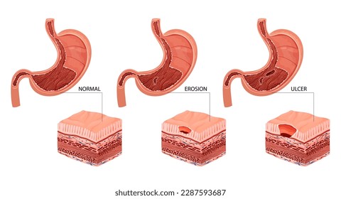 Stomach erosion and ulcer detailed vector illustration isolated on white background, cartoon style
