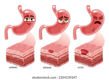 Stomach erosion and ulcer development. Cute happy, sad and crying stomach characters with faces and stomach cross section diagram. Anatomical vector illustration isolated on white background

