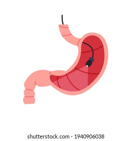 Stomach examination with camera isolated vector illustration. Gastroscopy design element. Tract system health care concept.