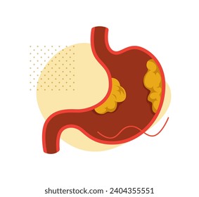 Stomach - Gastric - Cancer - Stock Illustration as EPS 10 File