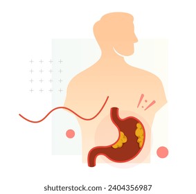 Stomach - Gastric - Cancer - Stock Illustration as EPS 10 File