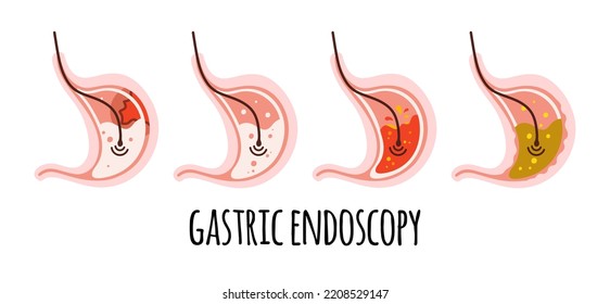 The stomach of a healthy person, with ulcers, gastritis, acidity. Gastroenterology. Vector illustration in a flat 