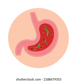 Stomach with Helicobacter pylori, ulcers and bacteria inside.