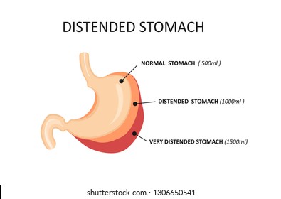 Stomach for obesity. Stretched stomach during overeating. Distended stomach