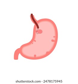 Órgano estomacal con pólipo, gastroscopia y pólipo de extracción. Comprobar la salud del estómago. Gástrico insalubre, problemas de indigestión, concepto de enfermedad. Riesgo de crecimiento de células cancerosas en el estómago. ilustración plana de Vector