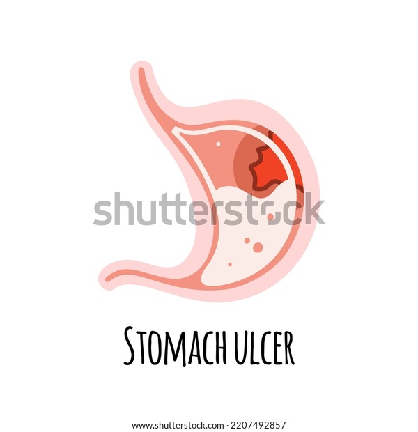 Stomach Person Ulcer Gastroenterology Vector Illustration Stock Vector ...