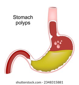 Stomatpolypen. Kreuzung des menschlichen Magens mit den Darmpolypen des Magens. Hyperplasie der Magenschleimhaut. bakterielle Infektion durch Helicobacter pylori. Vektorgrafik
