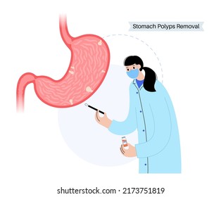 Stomach polyps diagnostic and removal. Consultation with doctor in clinic. Cancer awareness. Growth of cells in human internal organs. Gastric problems, digestive tract isolated vector illustration.