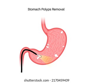 Stomach polyps diagnostic and removal. Endoscopy procedure concept. Cancer awareness. Growth of cells in human internal organs. Gastric problems, digestive tract isolated flat vector illustration.