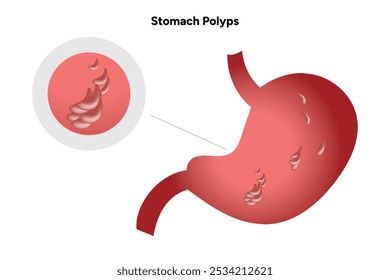 Stomach polyps. gastroenterology problem disease medical infographic 