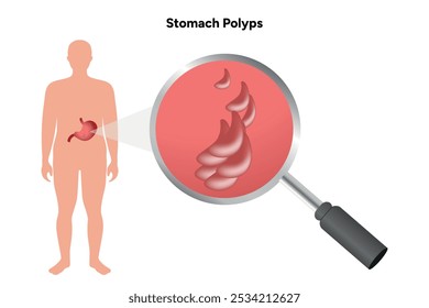 Pólipos estomacales. problema de gastroenterología enfermedad infografía médica 