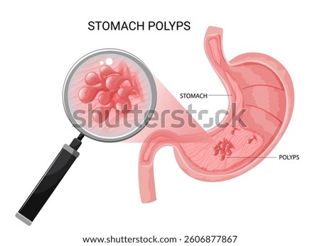 Stomach polyps, multiple gastric polyps under magnification. Digestive system disorder.Medical vector illustration.