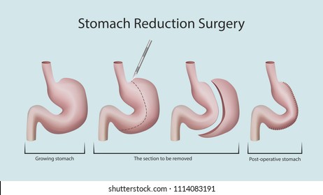 Magenreduktionsoperation