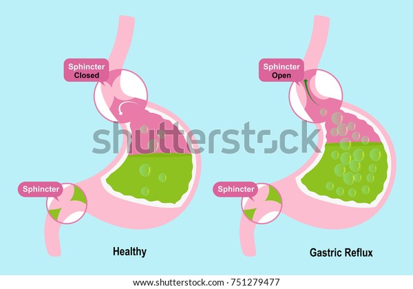 Stomach Sphincter On Blue Background Stock Vector (Royalty Free ...