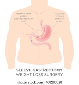 Stomach Staple Bariatric Surgery Resulting in 1/4 of the Stomach Removed.