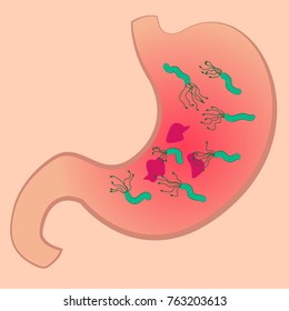 A Stomach with ucler and Helicobacter pylori