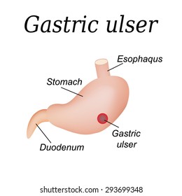 Stomach ulcer affected. Gastric ulcer. Vector illustration on isolated background.