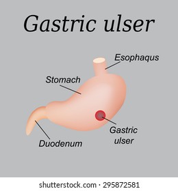 Stomach ulcer affected. Gastric ulcer. Vector illustration on a gray background.