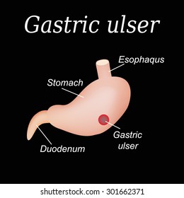 Stomach ulcer affected. Gastric ulcer. Vector illustration on a black background.