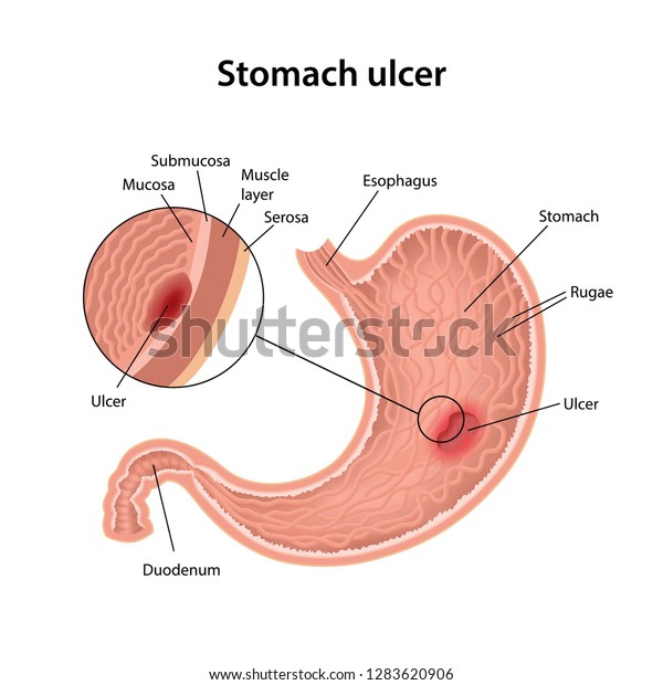 Stomach Ulcer Anatomical Vector Illustration Stomach Stock Vector ...