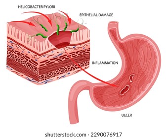 Stomach ulcer caused by helicobacter pylori infection. Detailed vector illustration, cartoon style
