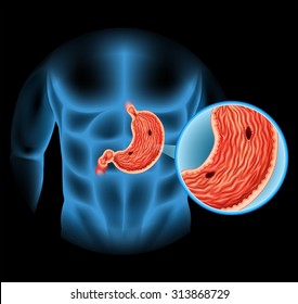 Stomach Ulcer Diagram In Human Illustration