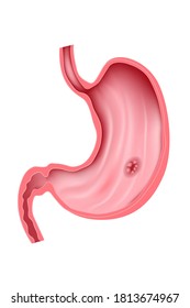 Stomach ulcer. Digestive system. Medical illustration of anatomy of an internal organ in section. Vector.
