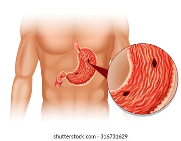 Stomach Ulcer In Human Body Illustration