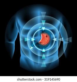 Stomach Ulcer In Human Body Illustration