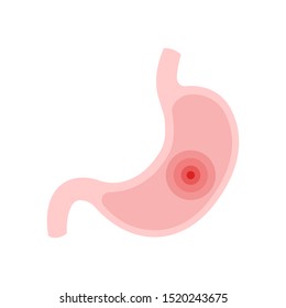 Stomach ulcer Isolated on white background. Vector illustration.