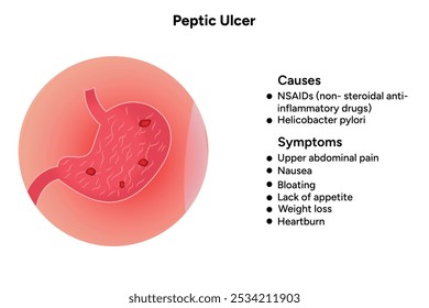 Stomach Ulcer symptoms and causes, peptic ulcer
