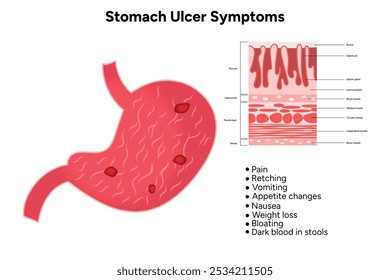 Stomach Ulcer symptoms. Medical information and diagram