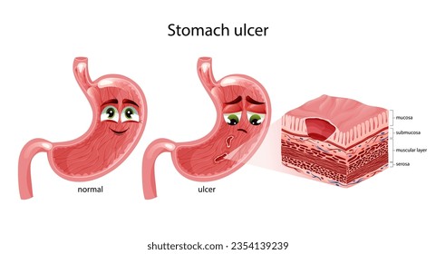 Stomach ulcers. Cute happy and sad stomach characters with faces. Stomach cross section diagram. Anatomical vector illustration isolated on white background
