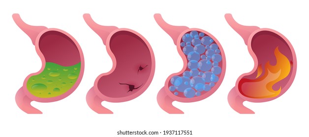 Stomach Upset, Gastritis, Bloating, Ulcers, Acidity, Overeating. Vector Cartoon Style.