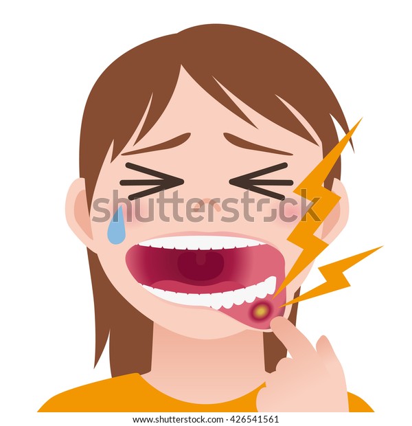 口内炎 口内炎 口腔粘膜の炎症 画像イラスト のベクター画像素材 ロイヤリティフリー