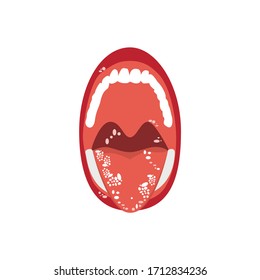 Stomatitis, Mouth Ulcers, Inflammation Of The Oral Cavity, White Spots On The Tongue, Open Mouth Vector Illustration In Cartoon Style Isolated On White Background