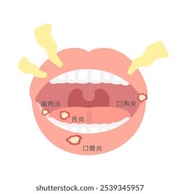 Tipos de estomatite tradução da ilustração: glossite, queilite angular, queilite, gengivite