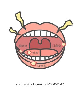 Tipos de estomatite tradução da ilustração: glossite, queilite angular, queilite, gengivite